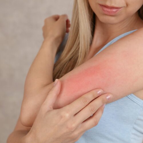 Conseils pour peau atopique et eczéma